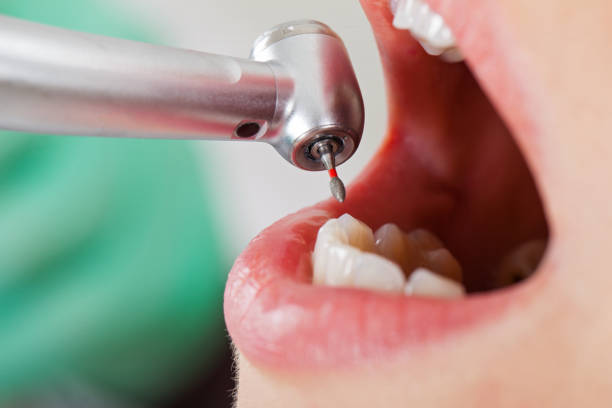 Best Emergency Dental Care for Abscessed Tooth in Garden Grove, FL